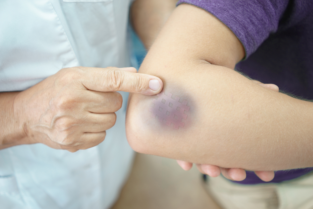 What does it mean when you bruise easily?