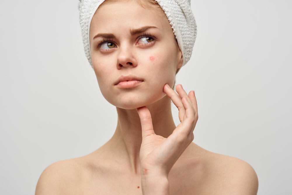 Does toothpaste really clear up pimples?