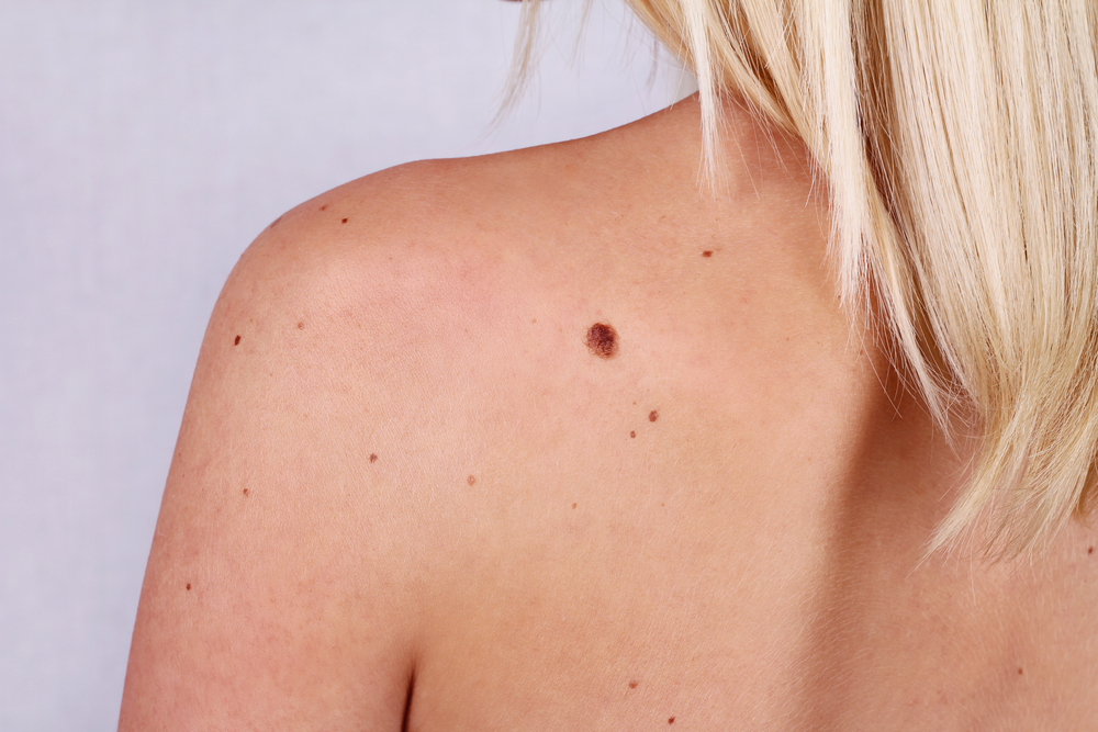 Should we be worried about moles?